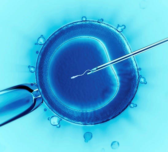 ICSI(Intracytoplasmic sperm Injection)