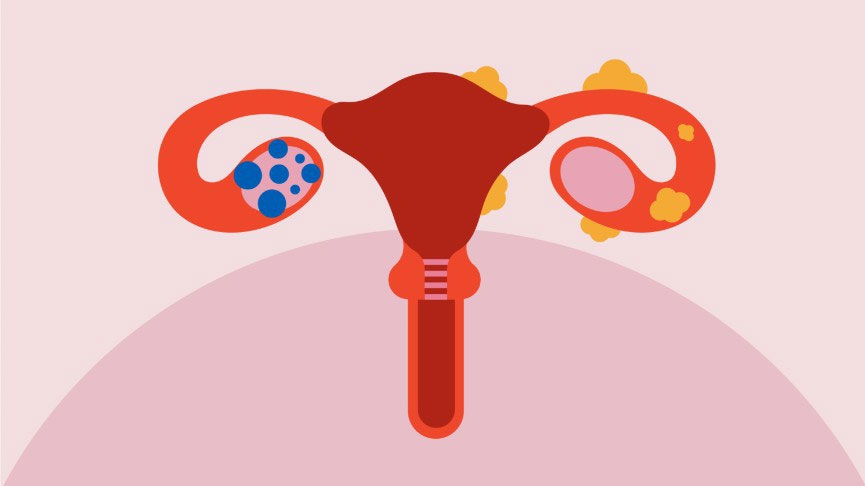 PCOD & PCOS Managment